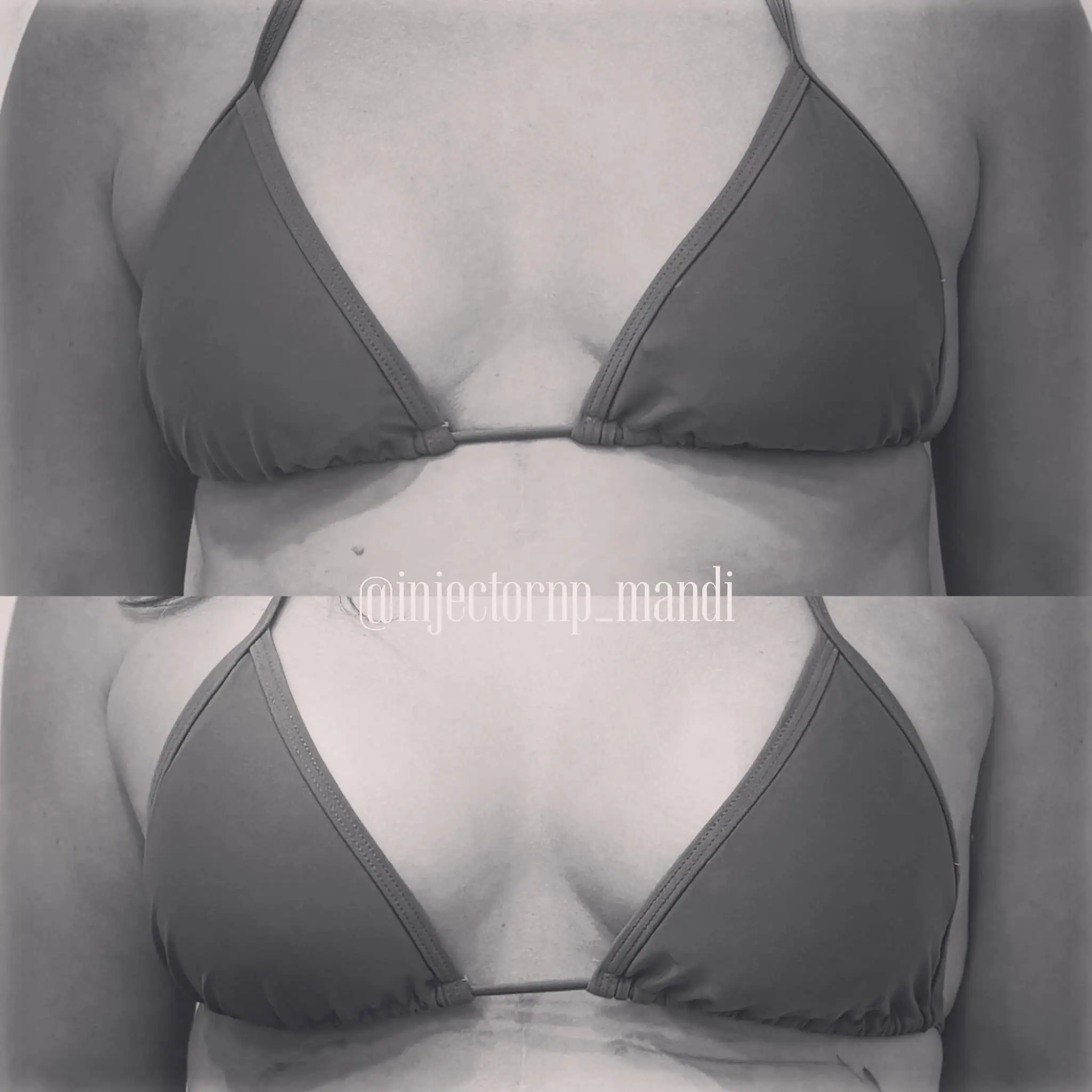 Fat transfer to breasts