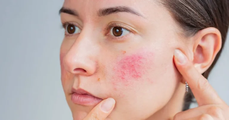 Close-up of woman's cheek showing redness and bumps for Acne Treatment, Riverdale, UT